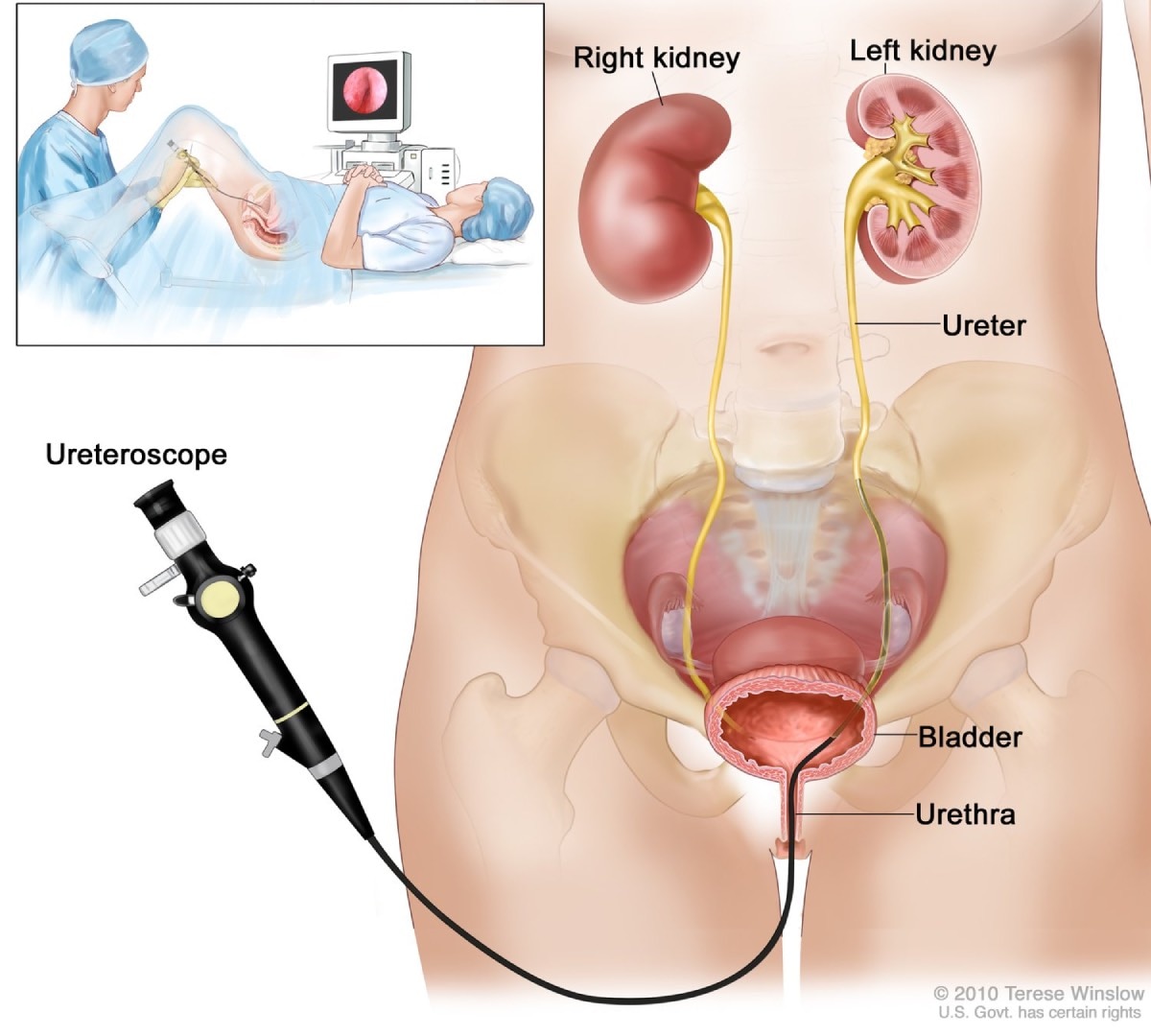Front-view drawing of lower pelvis containing the right and left kidneys, ureter, bladder, and urethra. The flexible tube of a ureteroscope—a thin, tube-like instrument with a light and a lens for viewing—is shown passing through the urethra into the bladder and ureter. Inset of a woman on an examination table and a urologist looking at a computer monitor.