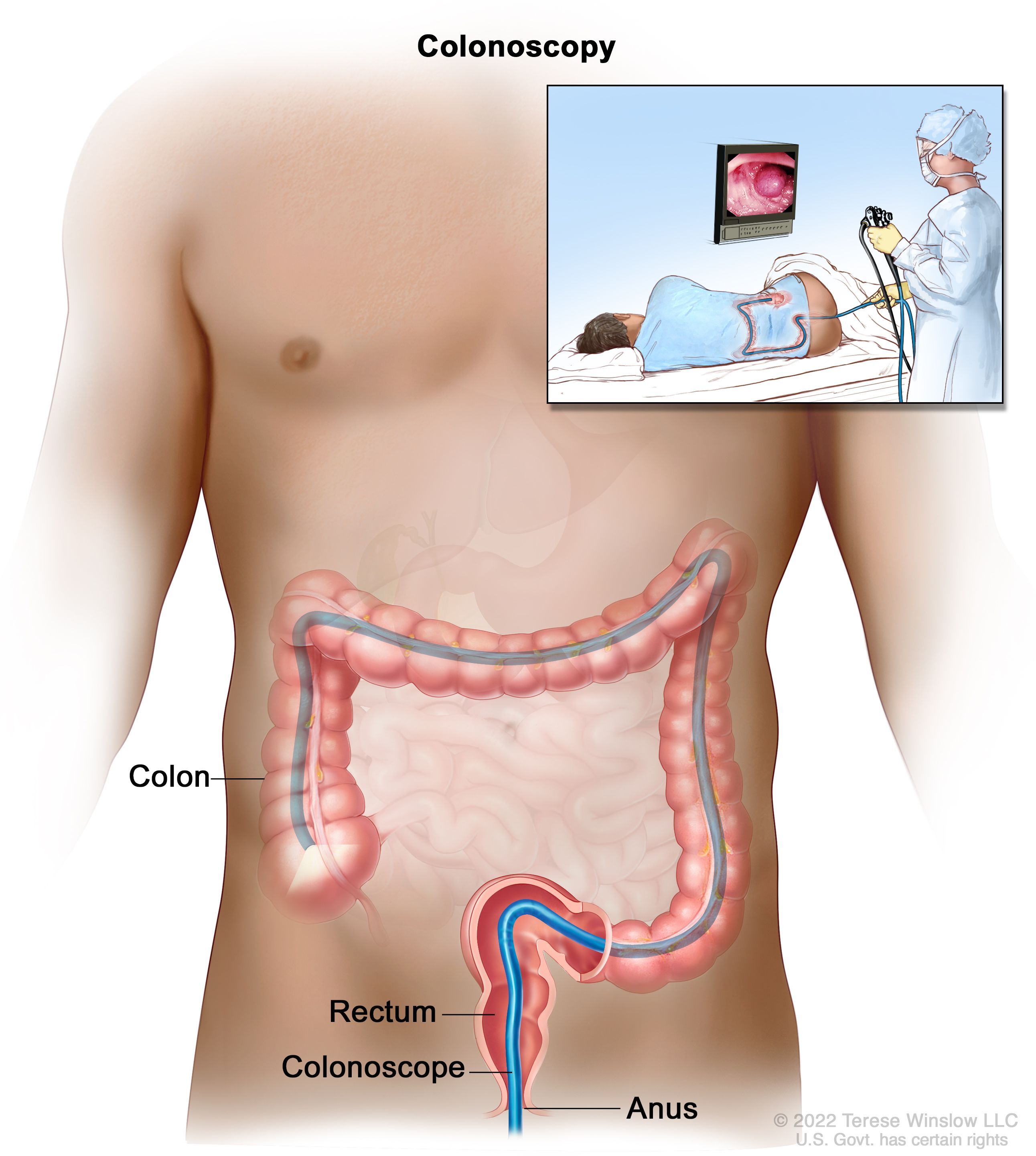 A colonoscope inserted in the anus, rectum, and colon. An inset shows a health care professional performing a colonoscopy and a patient on their side.