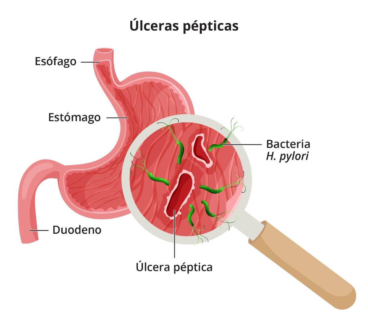 Primer plano de unas úlceras pépticas, que muestra el daño en el revestimiento del estómago causado por la bacteria H. pylori.