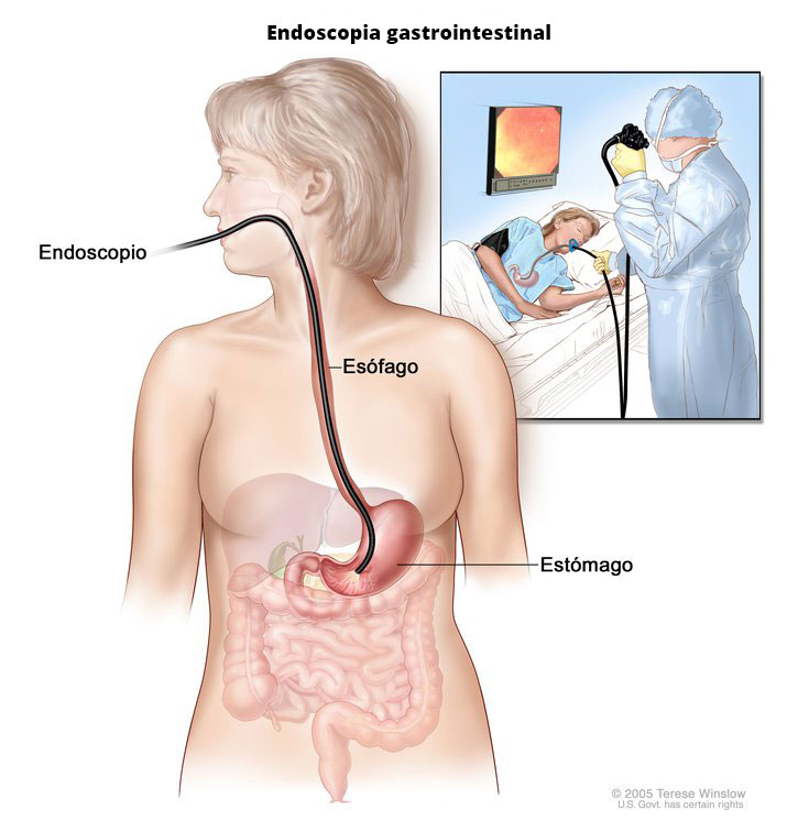 Ilustración de un endoscopia gastrointestinal
