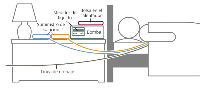 Dibujo de una persona acostada al lado de una mesa de noche con una bolsa de calentamiento, un medidor de líquido, una bomba y dos fuentes de suministro de solución. Las líneas conectan los suministros de la solución a la persona. Una línea de drenaje está conectada de la persona y sale fuera del marco del dibujo.