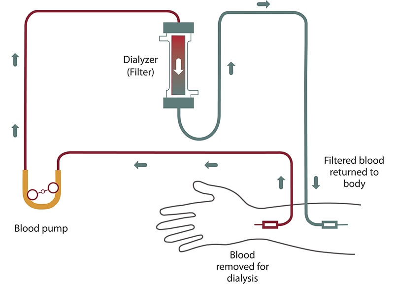 Diagram of hemodialysis blood flow from your arm into a tube and past a blood pump to the filter. Filtered blood flows back into your arm.