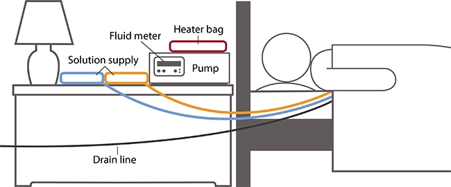 Drawing of person in bed next to a nightstand with a heater bag, fluid meter, pump, and two solution supply sources. Lines connect the solution supplies to the person. A drain line connects from the person and out of the frame of the drawing.
