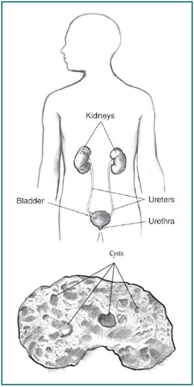Drawing of a male torso with kidneys, ureters, bladder, and urethra labeled, and a drawing below of a kidney with sacs of fluid labeled as