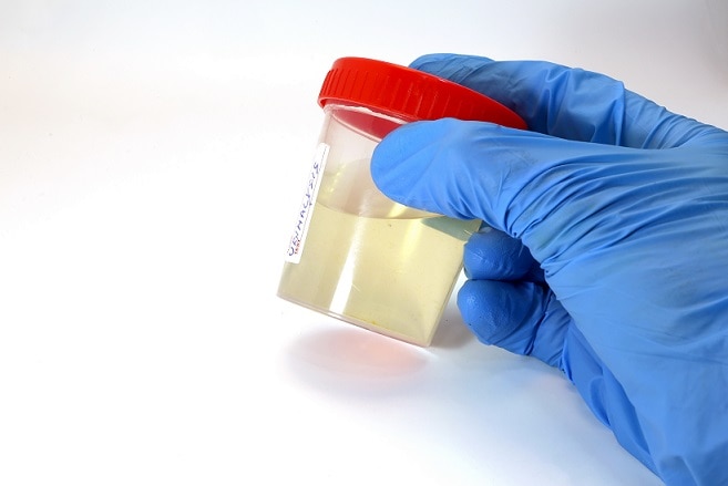 A hand wearing an exam glove holds a container of urine.