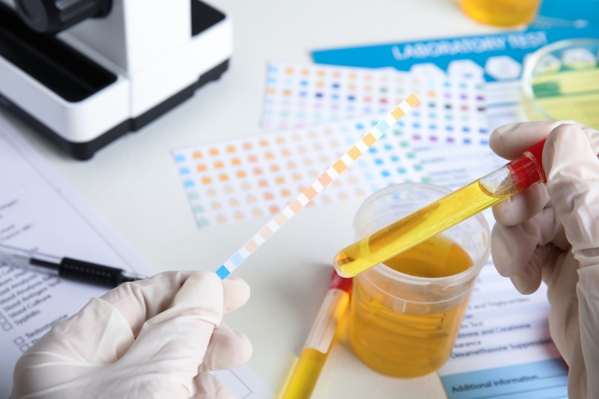 A lab technician holds a urine sample and urine test strip.