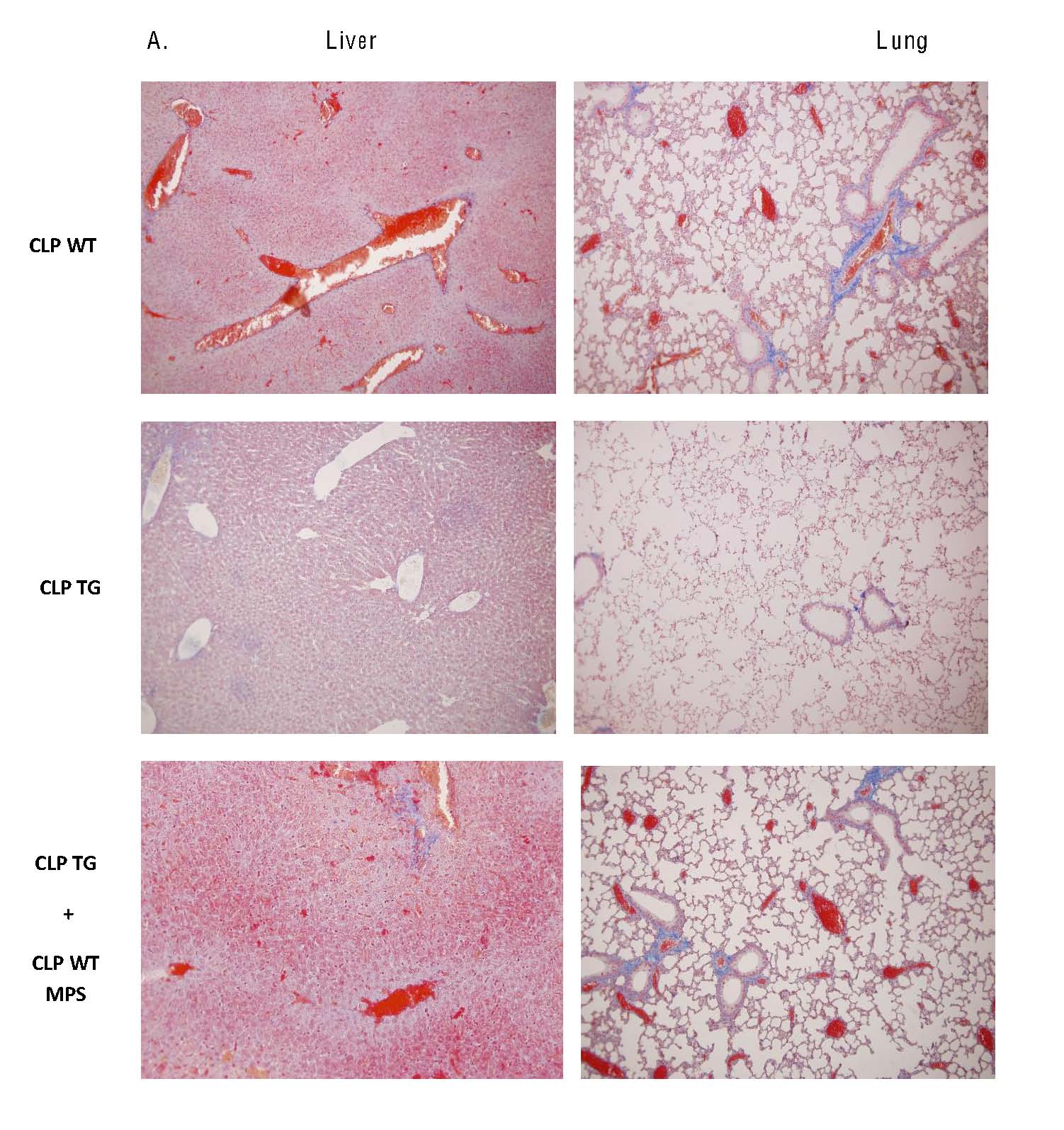 Microparticles and fibrin deposition in sepsis.